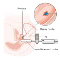 Prostate-Biopsy-Procedure-300×291 Prostate-Biopsy-Procedure-300x291