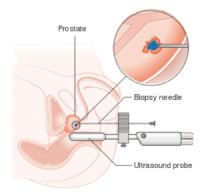 Prostate-Biopsy-Procedure-300x291